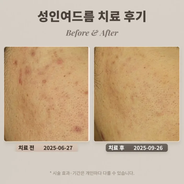 20대 성인여드름 치료 후기 #한티역피부과전문의