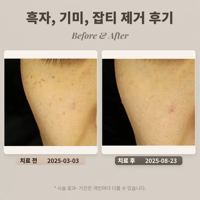 40대 여성 흑자, 기미, 잡티 제거 후기_한티역피부과 후기