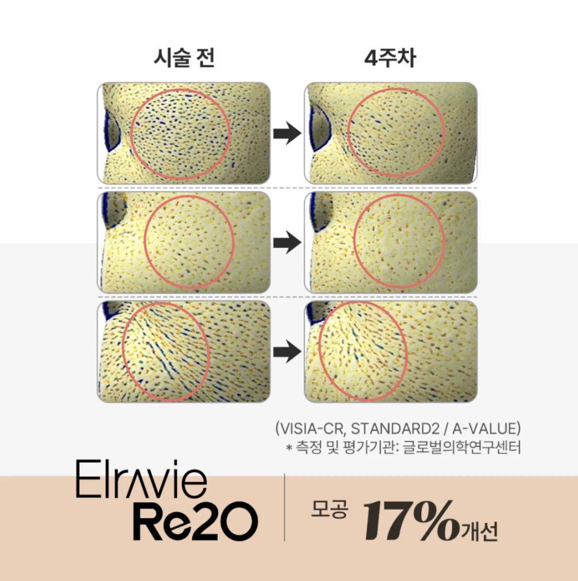 VISIA-CR로 측정한 시술 전과 4주차의 모공 비교 이미지 — Elravie Re2O 임상 평가 자료