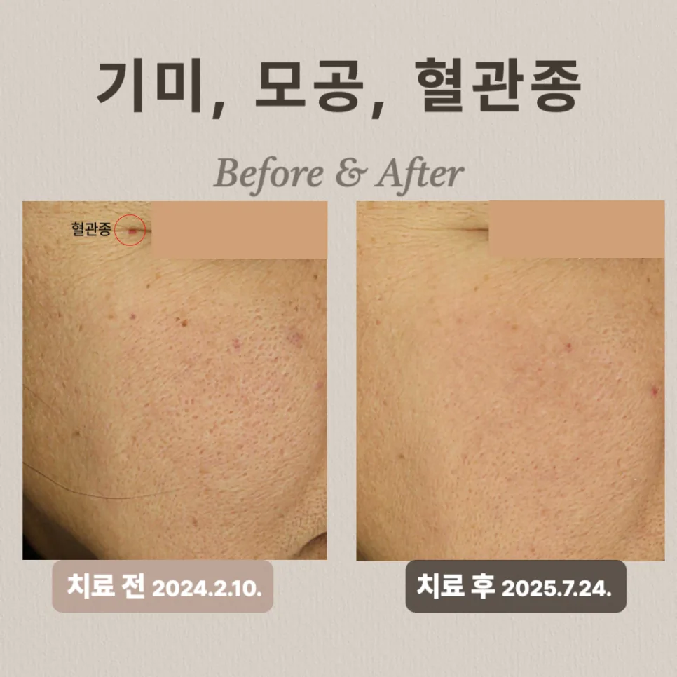 40대 도자기 프로그램 후기: 기미·모공 개선 비법!