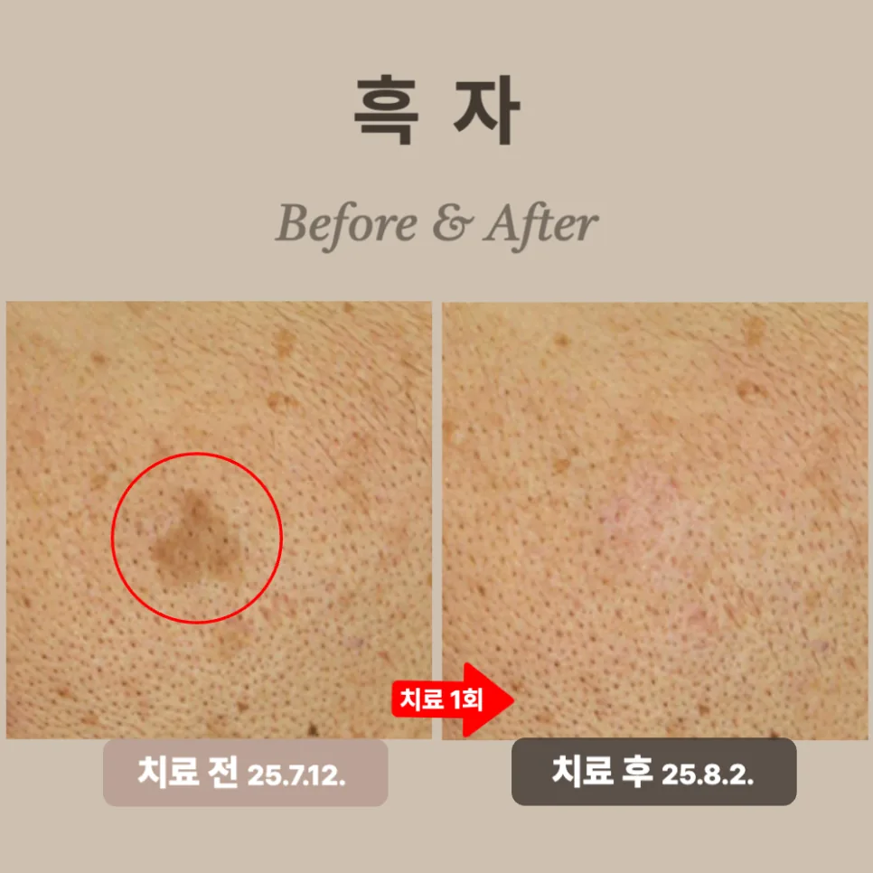 50대 리팟레이저 시술 후기: 경계 뚜렷한 흑자 제거 성공!