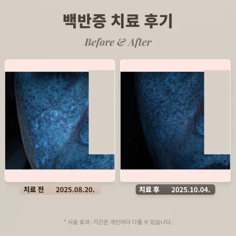 40대 백반증 남성 치료 후기 #백반증 치료기간 길까?