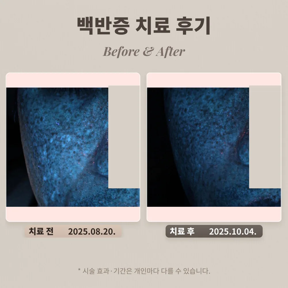 40대 백반증 남성 치료 후기 #백반증 치료기간 길까?
