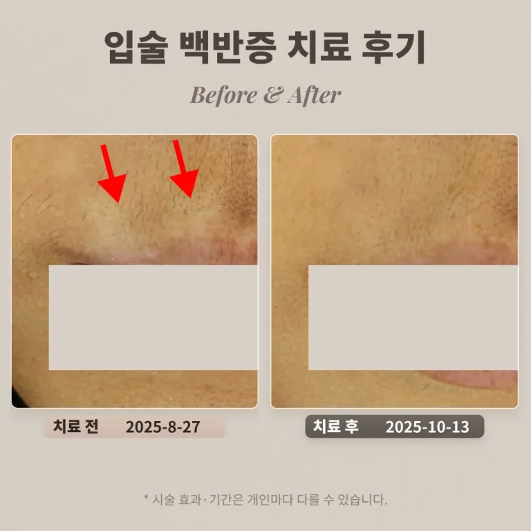 30대 입술 백반증 치료 후기 #백반증 조기 치료 방법
