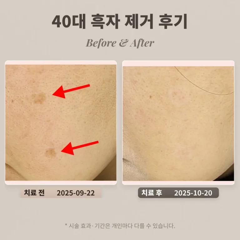 40대 일광 흑자 제거 후기 #강남피부과전문의