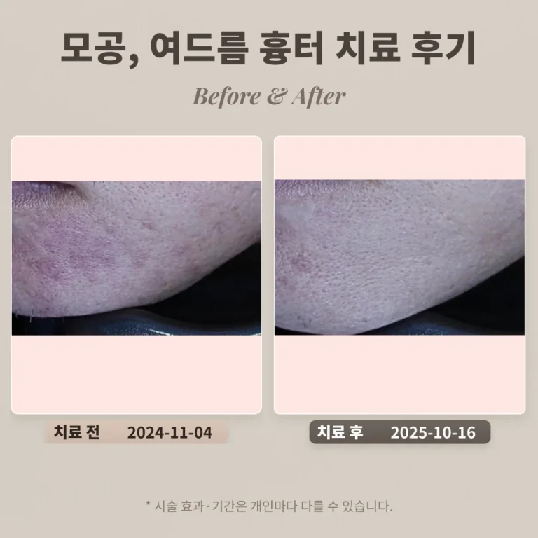 모공, 여드름 흉터 치료 후기 #도자기 피부를 위한 치료과정