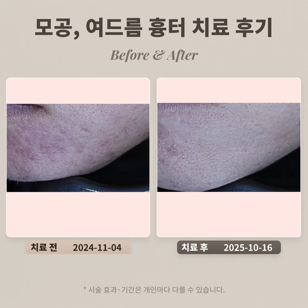 모공, 여드름 흉터 치료 후기 #도자기 피부를 위한 치료과정