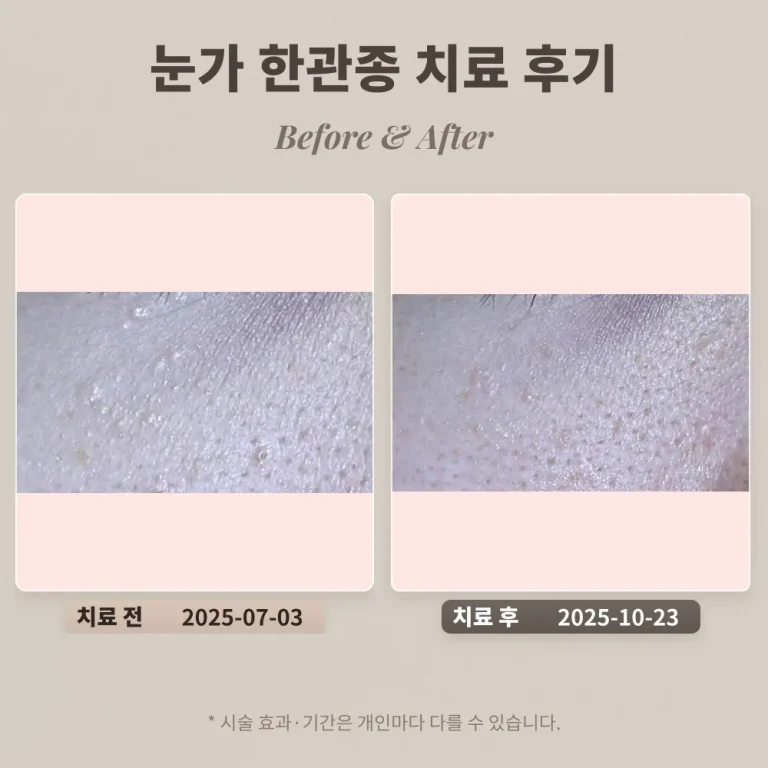 눈가 한관종 치료 후기 #비립종, 편평사마귀와 비교되는 한관종
