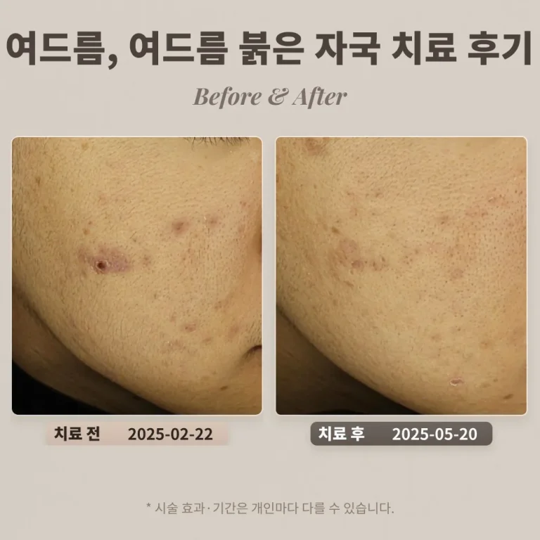 10대 여드름, 여드름 붉은 자국 치료 후기