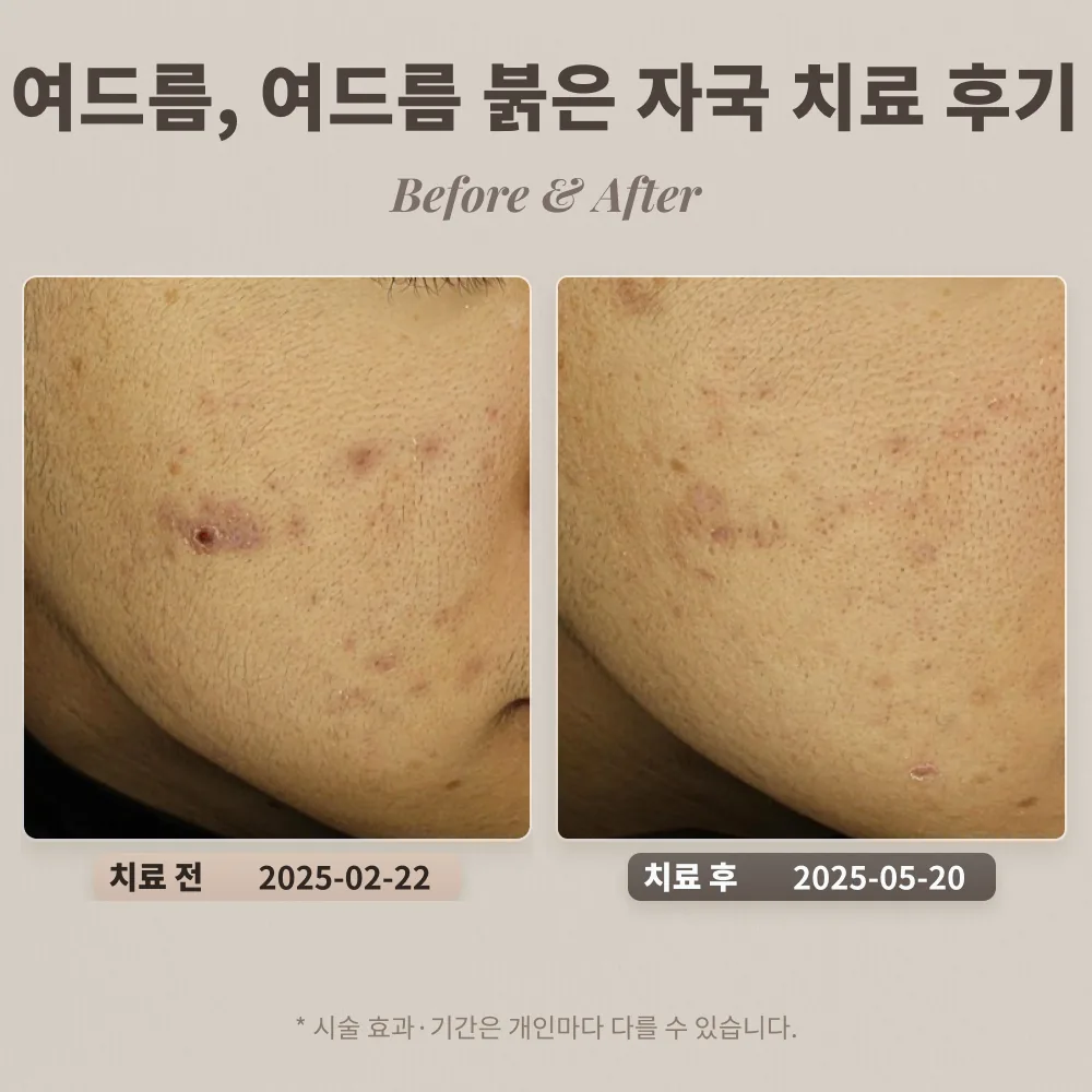 10대 여드름, 여드름 붉은 자국 치료 후기