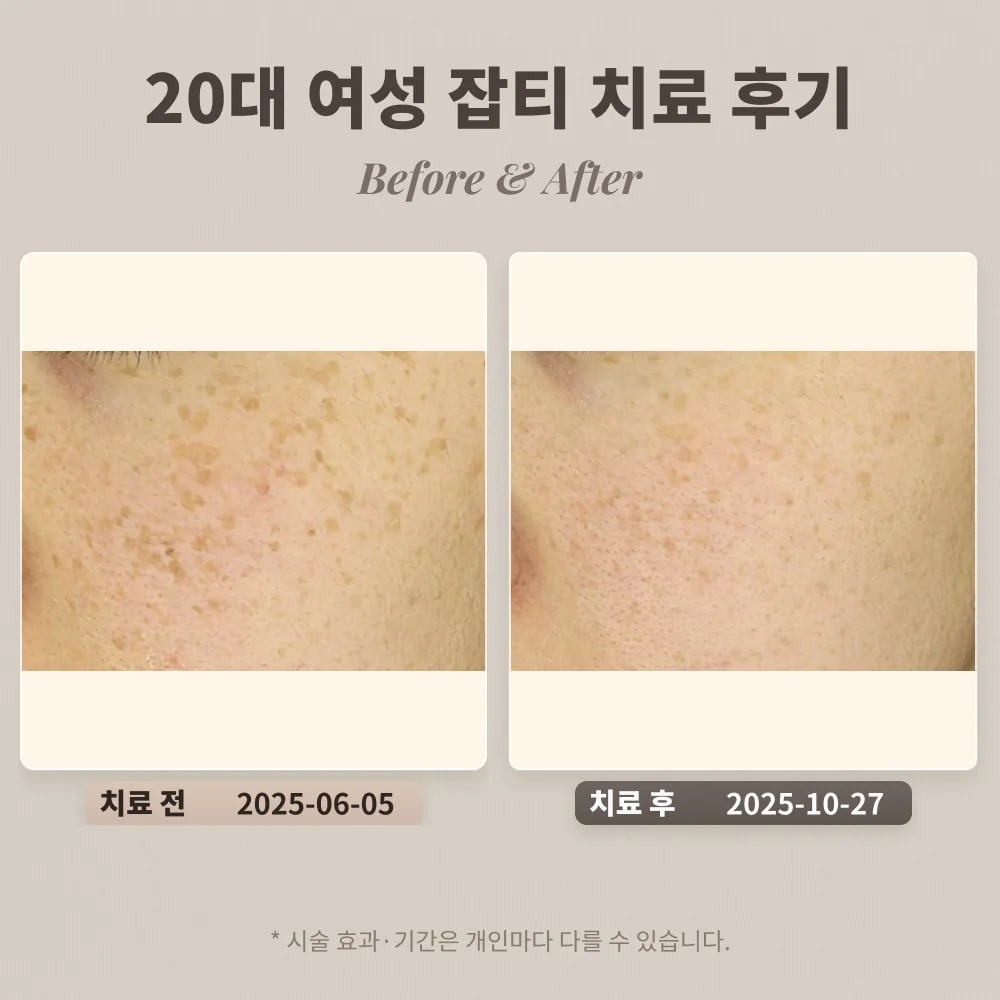 20대 여성 잡티 치료 후기