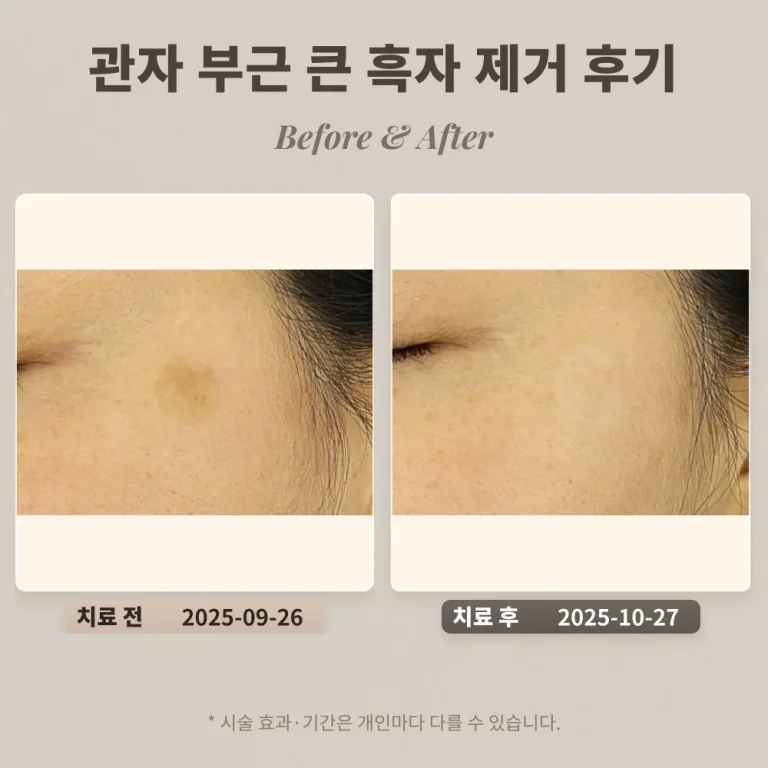 30대 여성 관자 부근 큰 흑자(갈색 반점) 제거 후기