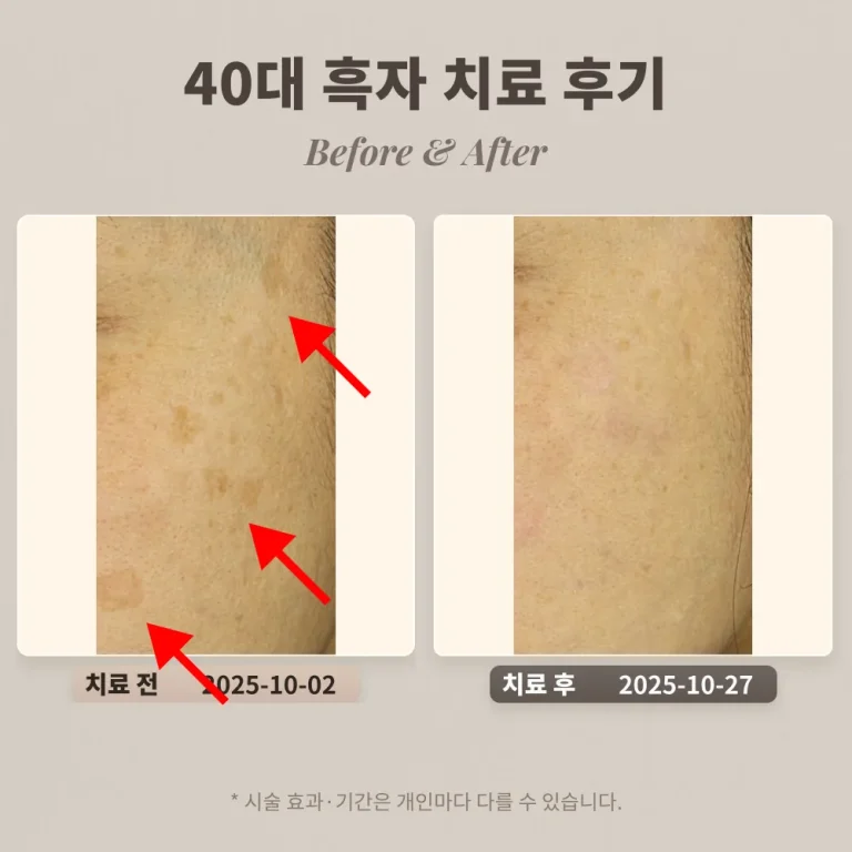 40대 여성 얼굴 곳곳에 있는 흑자 치료 후기_한티 피부과