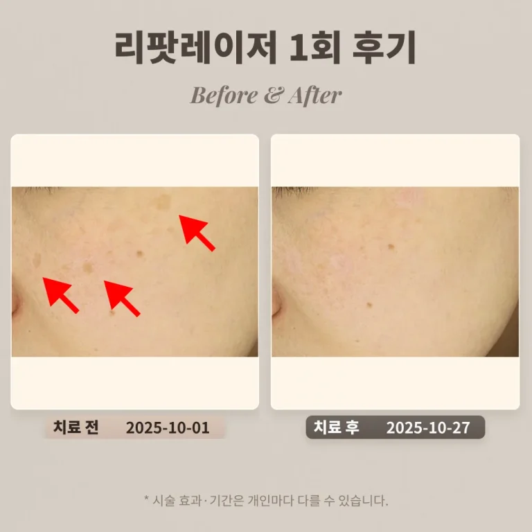 40대 여성 흑자 리팟레이저 1회 후기_한티피부과