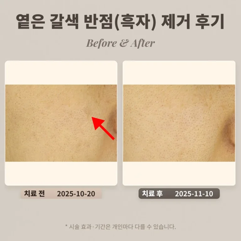 30대 옅은 갈색 반점(색소침착으로 오인) 제거 후기