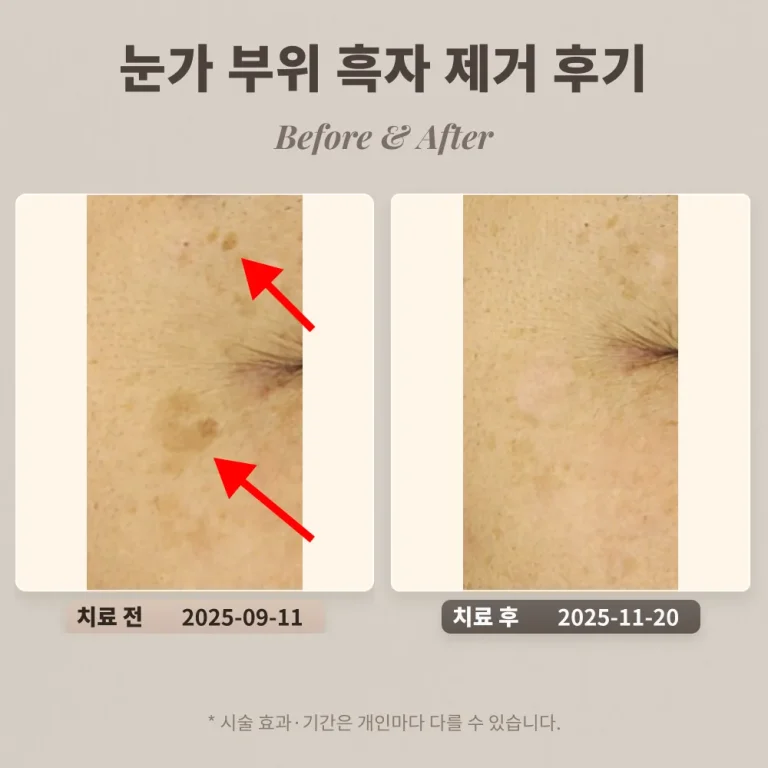 대치피부과 40대 눈가부위 흑자 제거 후기