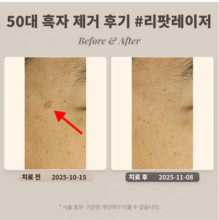 50대 흑자 제거 레이저 치료 후기 #리팟레이저