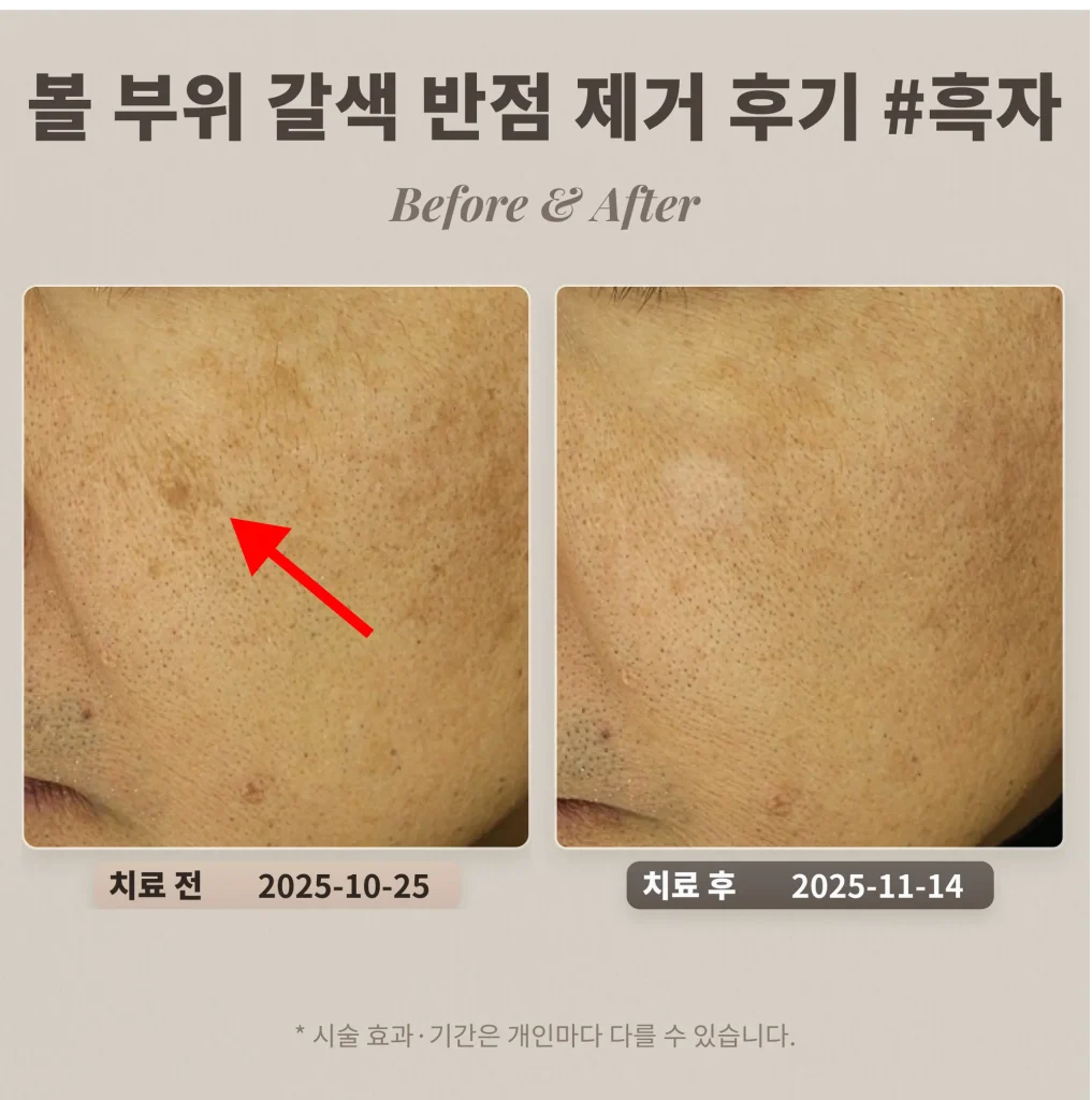 볼 부위 갈색 반점(흑자) 제거 후기 #흑자 제거 레이저 치료