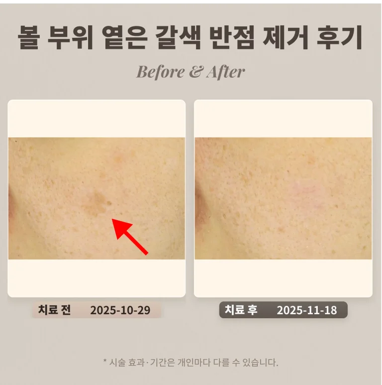 30대 여성 볼 부위 큰 옅은 갈색 반점(흑자) 제거 후기