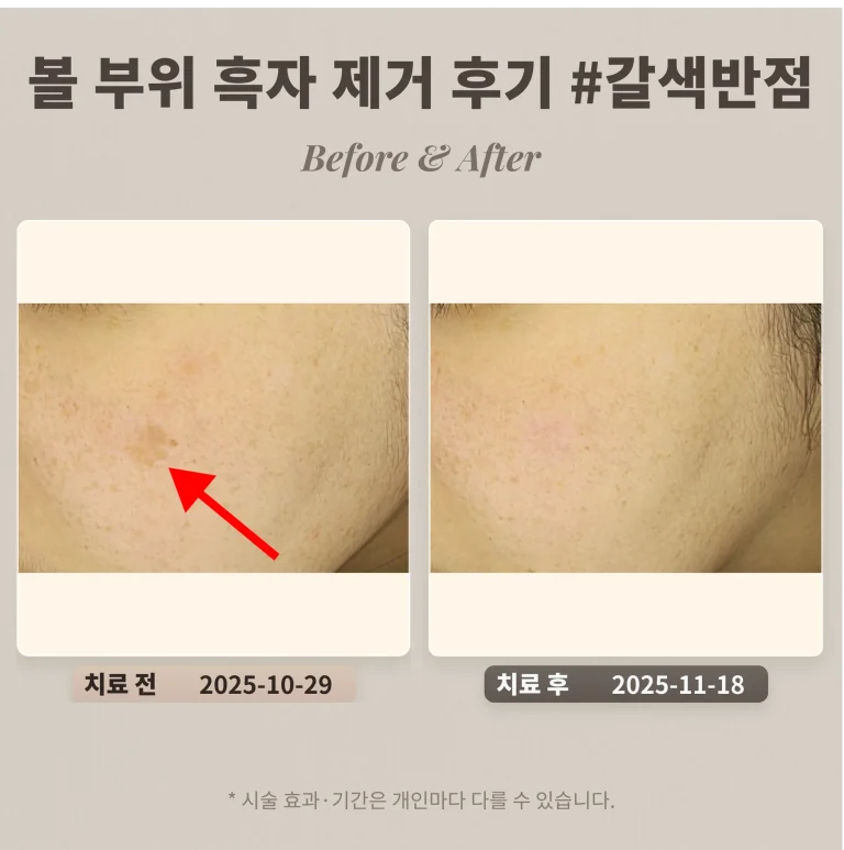 30대 볼 부위 흑자 리팟레이저로 제거 후기 #갈색반점