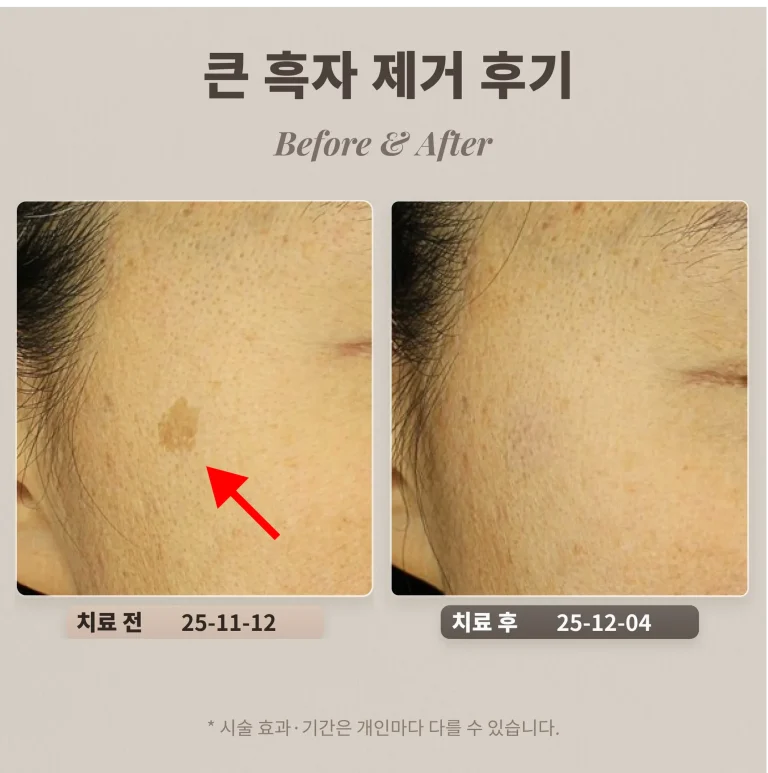 40대 눈가 큰 흑자 제거 후기_제거시 주의할 점