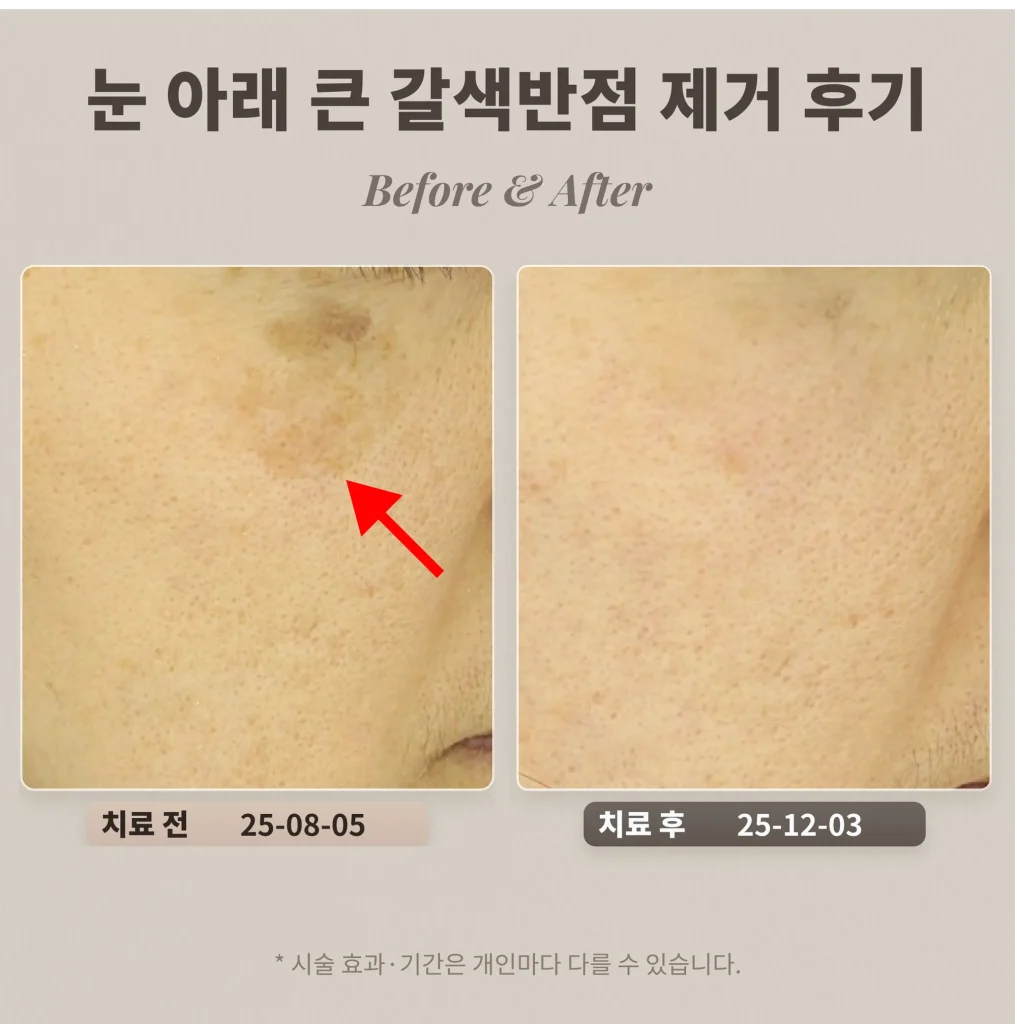 40대 여성 눈 아래 큰 갈색반점(색소침착 오인) 제거 후기_리팟레이저 후기