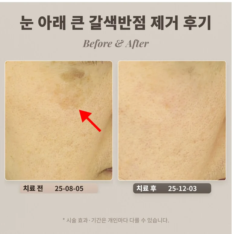 40대 여성 눈 아래 큰 갈색반점(색소침착 오인) 제거 후기_리팟레이저 후기