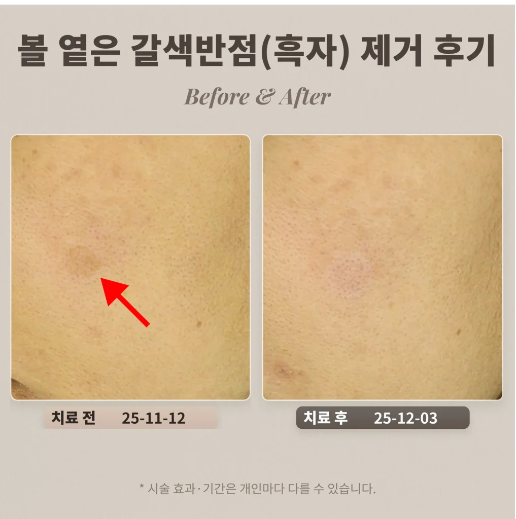 40대 여성 볼 부위 옅은 갈색반점(흑자) 제거 후기_강남 피부과 후기