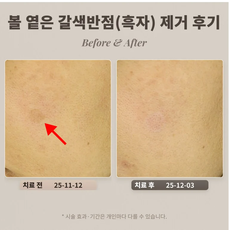 40대 여성 볼 부위 옅은 갈색반점(흑자) 제거 후기_강남 피부과 후기