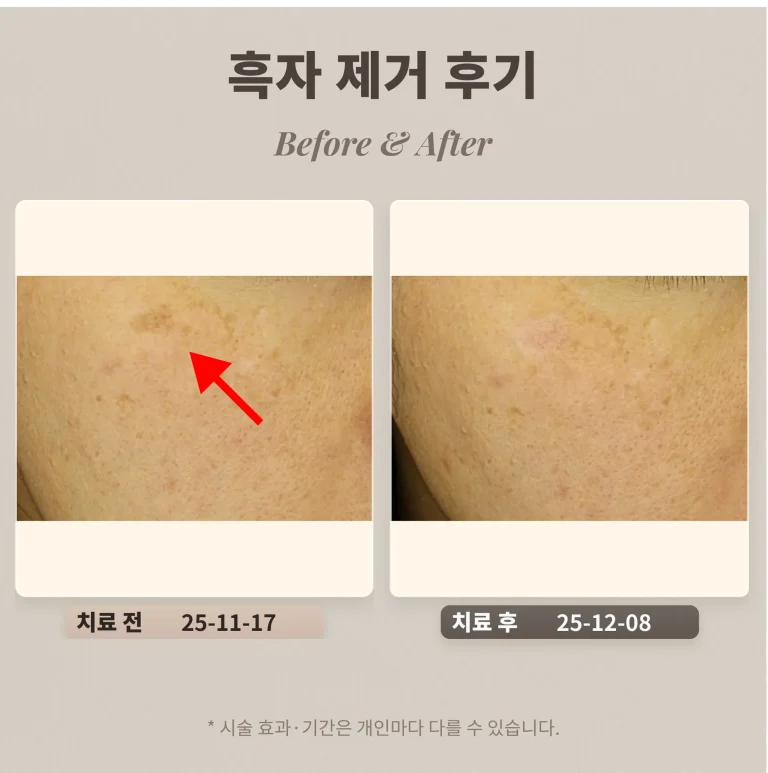 40대 흑자, 리팟레이저로 제거한 피부과 후기