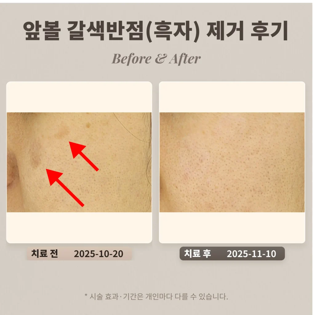 30대 앞볼 부위 갈색반점(색소침착)으로 알고 계셨던 여성의 흑자 제거 후기