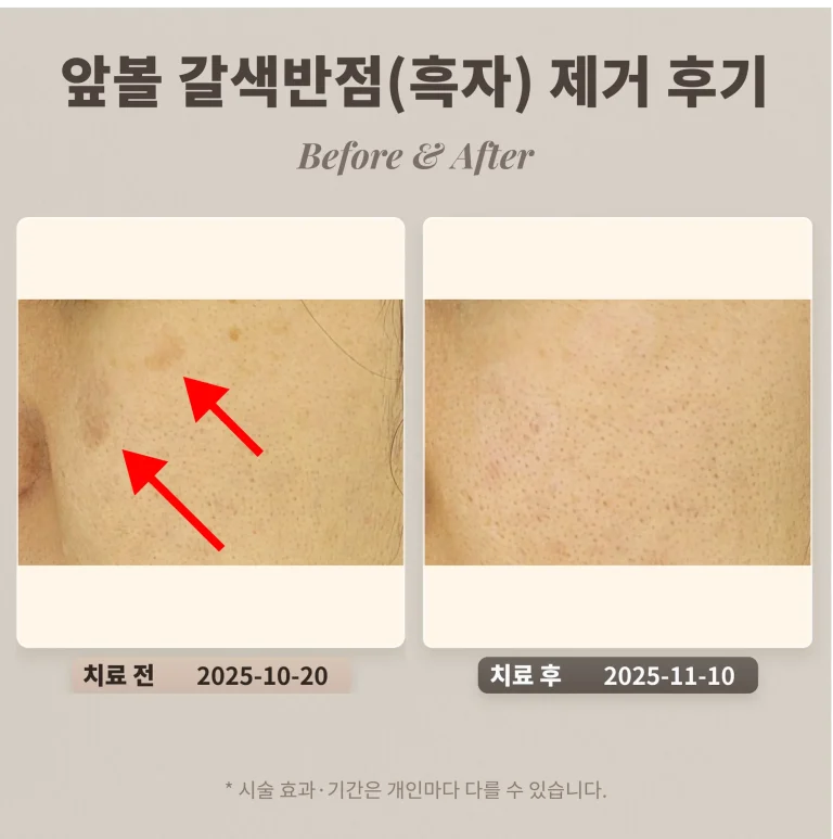 30대 앞볼 부위 갈색반점(색소침착)으로 알고 계셨던 여성의 흑자 제거 후기