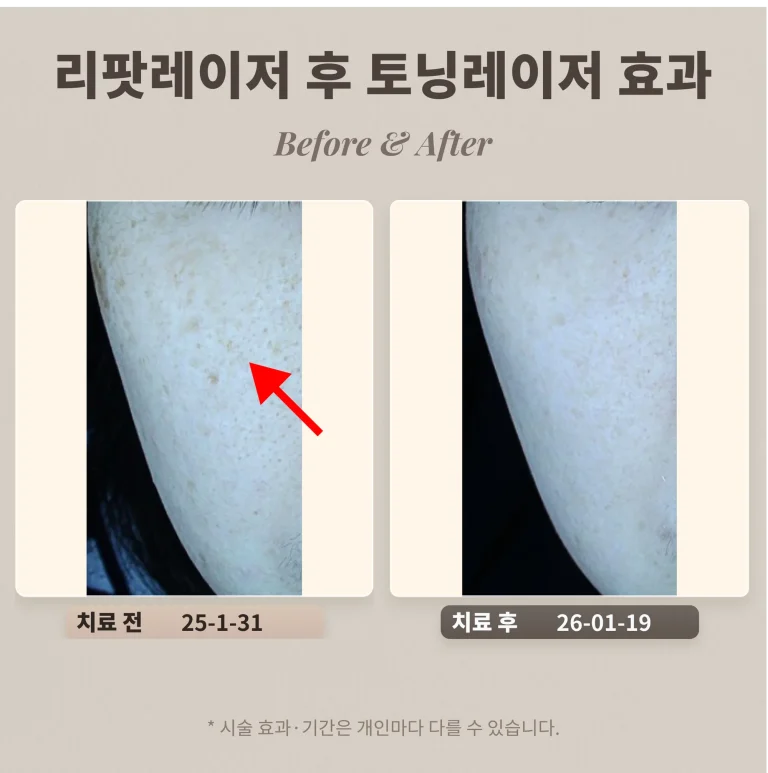 리팟레이저 후 토닝치료 어떤 효과가 있을까?