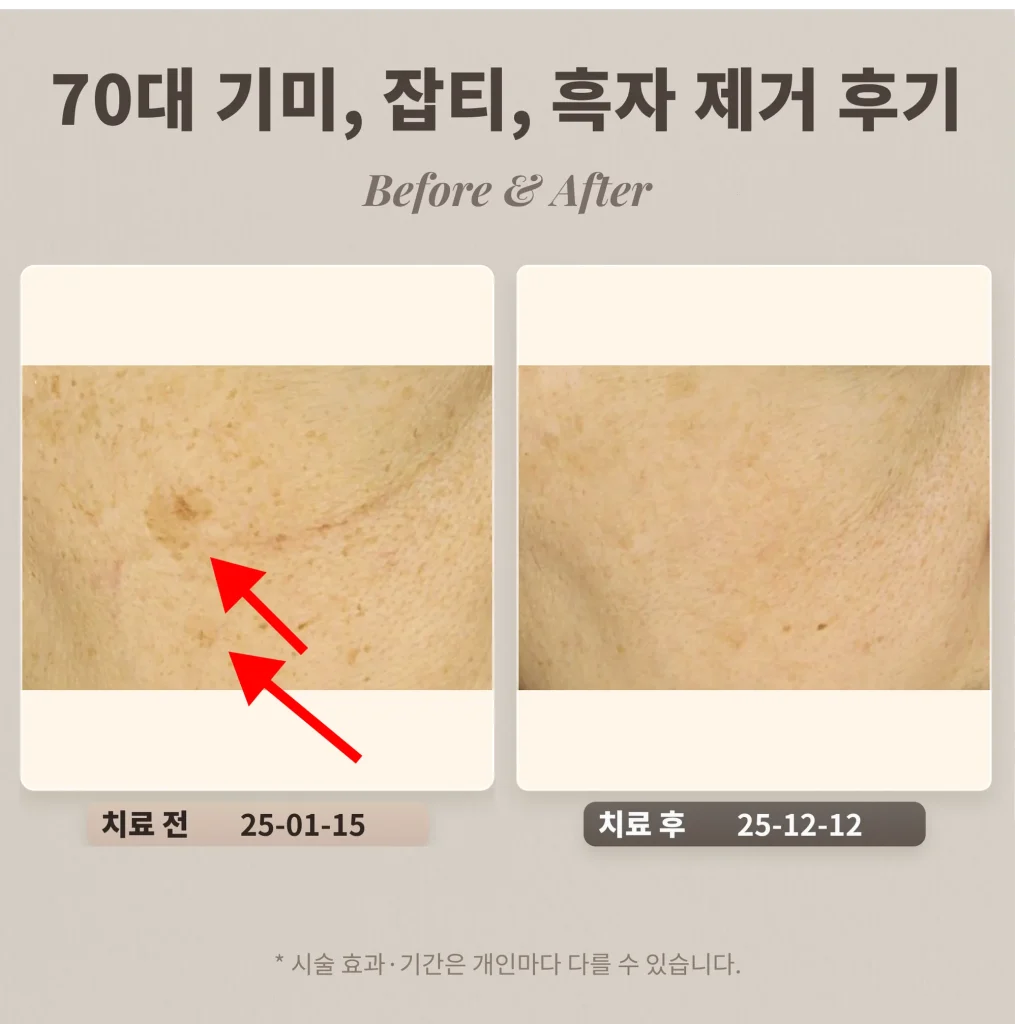 70대 기미, 잡티, 흑자 제거 후기