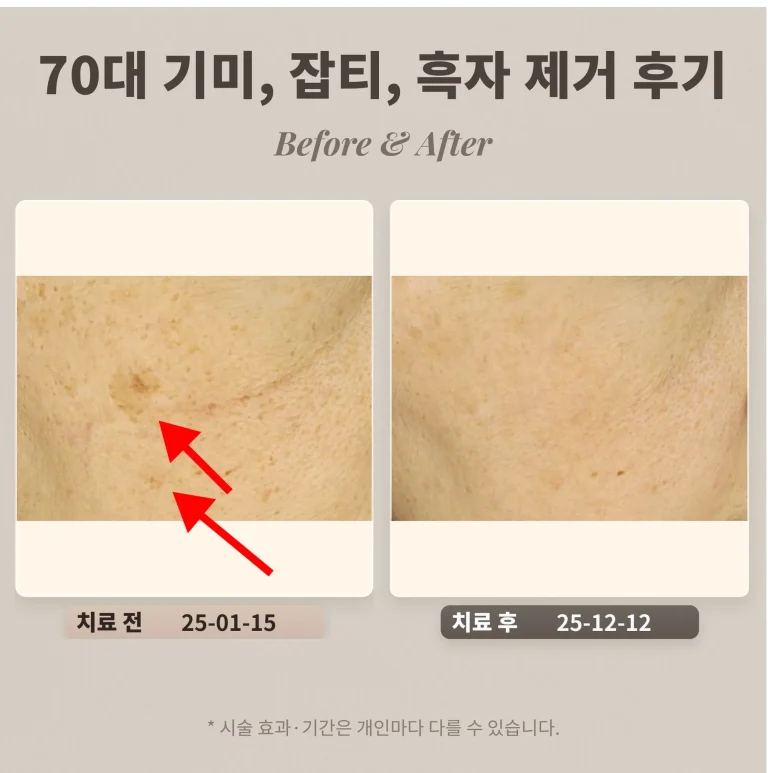 70대 기미, 잡티, 흑자 제거 후기