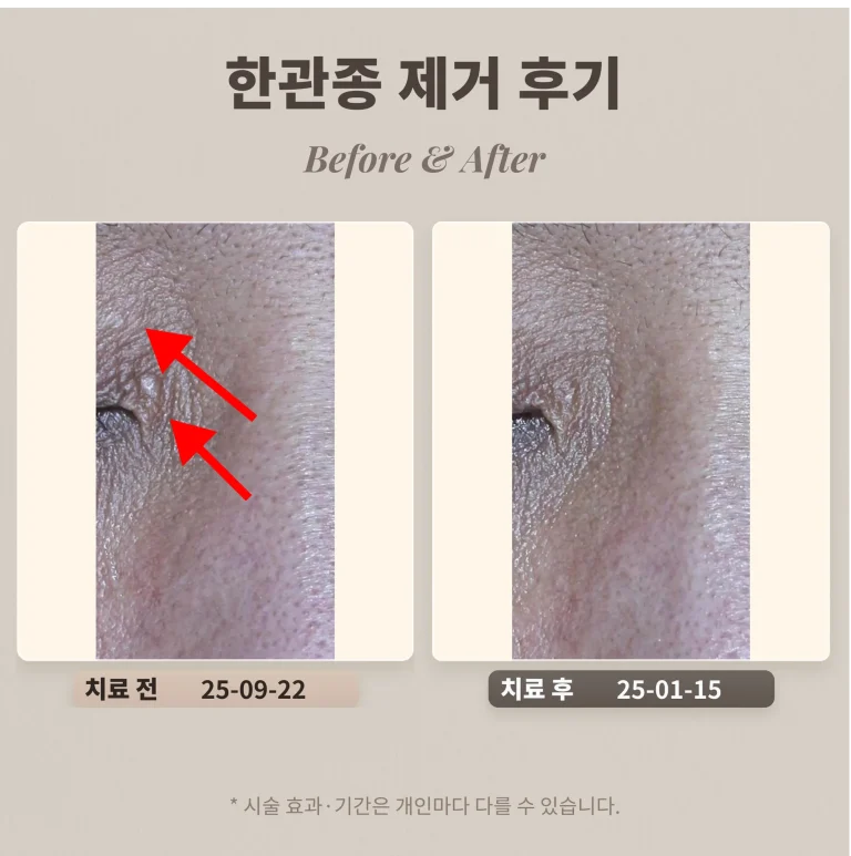 눈가 오돌토돌난 병변은 뭘까?한관종 제거 후기_강남 피부과 전문의