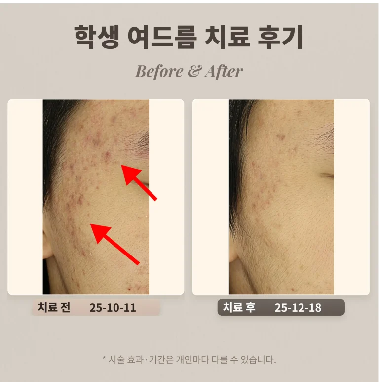 10대 학생 여드름 치료 후기_한티역 여드름 피부과