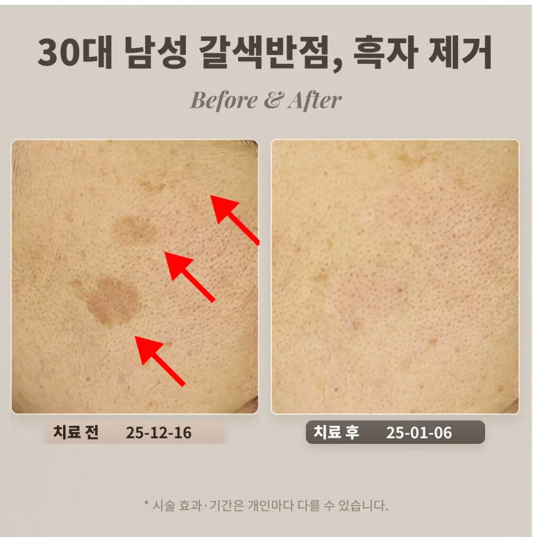 30대 남성 갈색반점, 흑자 제거 사례_리팟레이저 후기