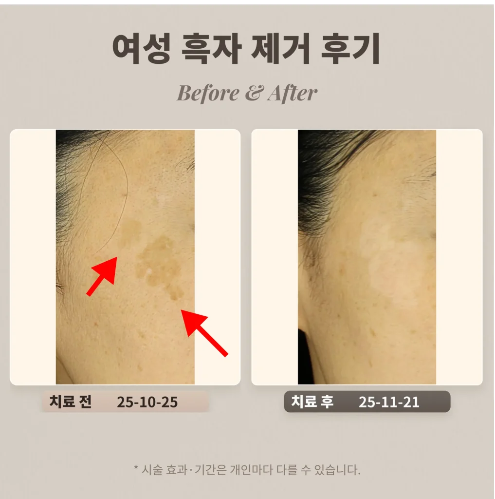 40대 여성 흑자 제거 후기_ 리팟레이저 후기
