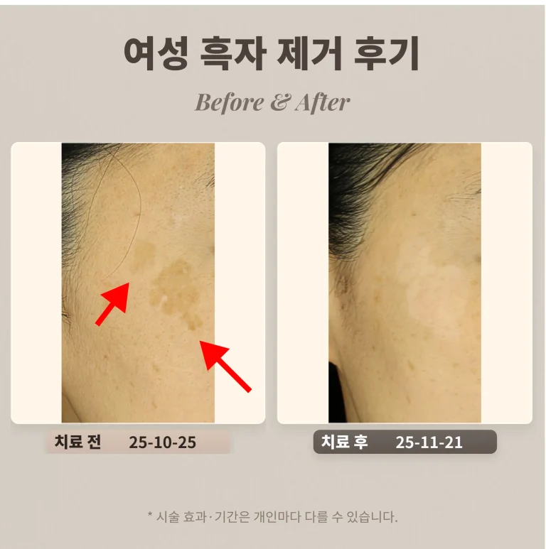 40대 여성 흑자 제거 후기_ 리팟레이저 후기
