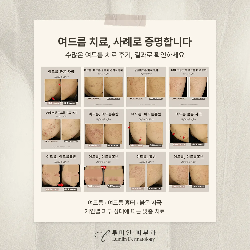 루미인피부과 여드름 치료 후기 공유