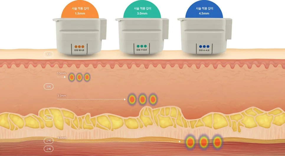 시술 깊이