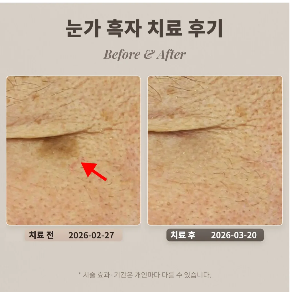눈가 흑자 치료 후기