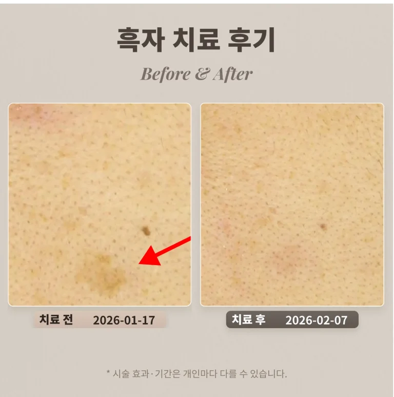 흑자 치료 후기