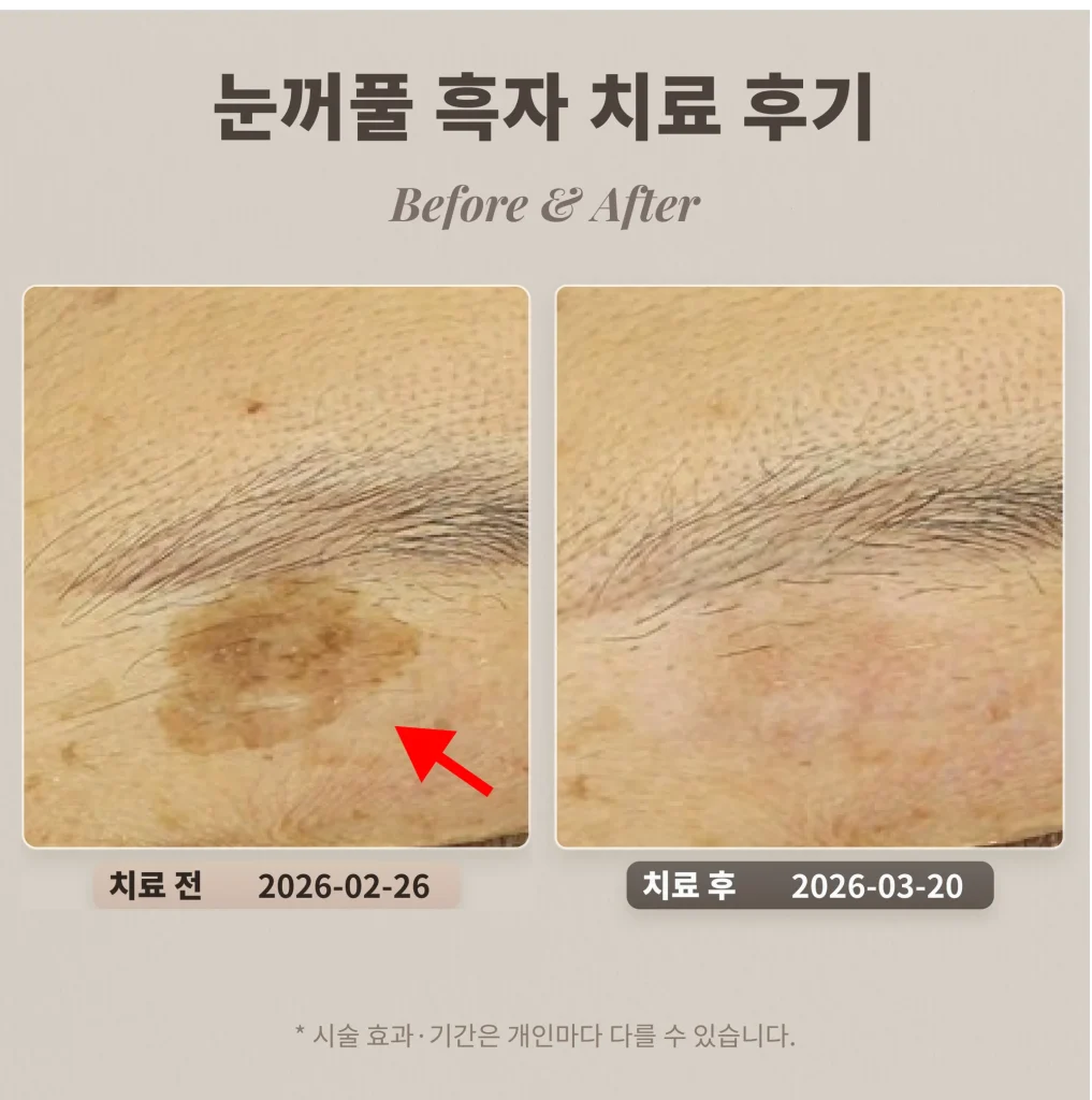 눈꺼풀 흑자 치료 후기