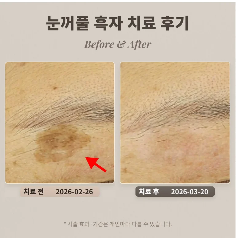 눈꺼풀 흑자 치료 후기