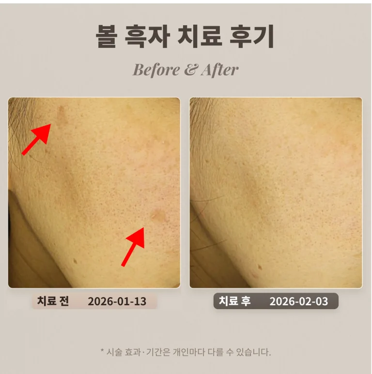 볼 흑자 치료 후기