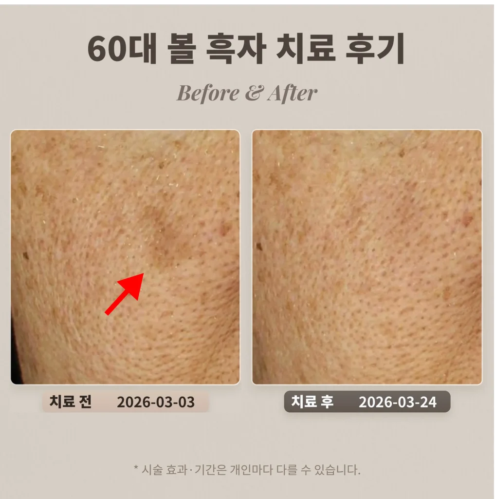 60대 볼 흑자 치료 후기