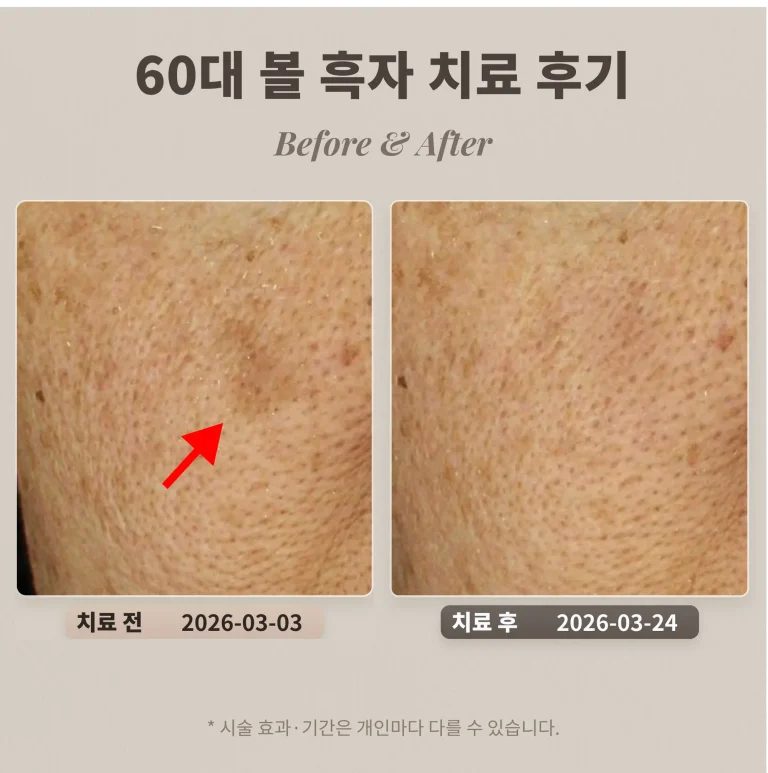 60대 볼 흑자 치료 후기