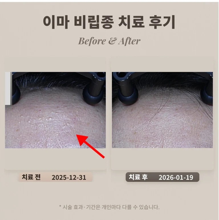 이마 비립종 치료 후기